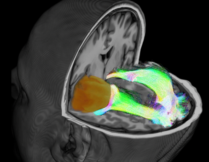 A 3D image of a brain cross-section, taken with the CONSULT tool