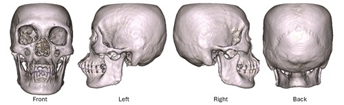 Imaging from a dataset of 200 CT scans was analysed for sex-associated traits by the AI algorithm.